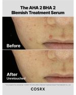 سرم درمان جوش و لک صورت کوزارکس حاوی Aha و Bha لایه برداری و پاکسازی پوست - تصویر 4